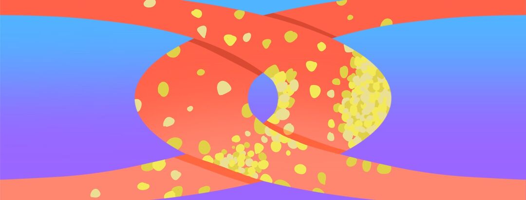 How Are High Cholesterol and Obesity Linked? image