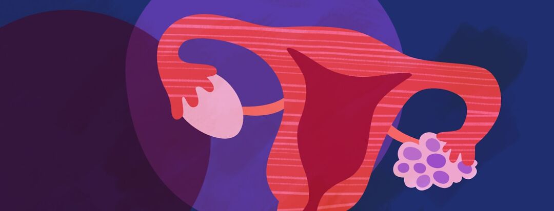 Obesity, the Menstrual Cycle, and PCOS image